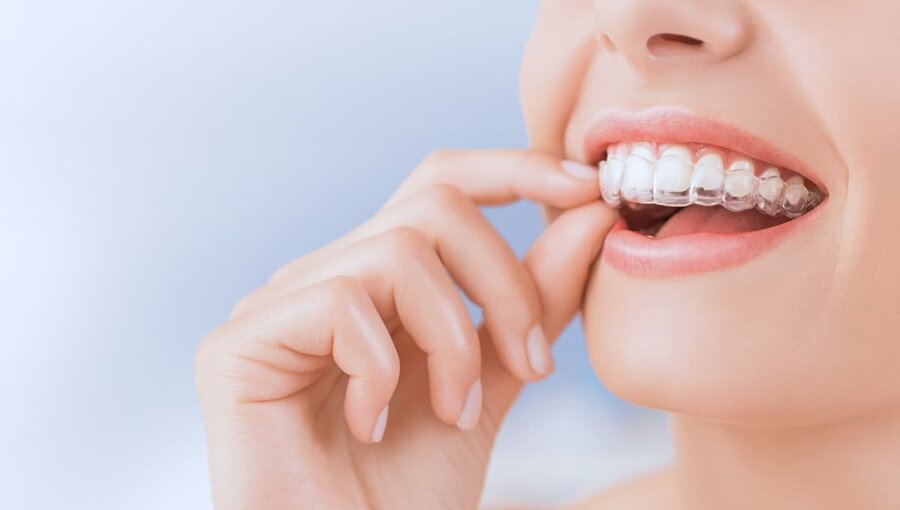 Clear aligner tray