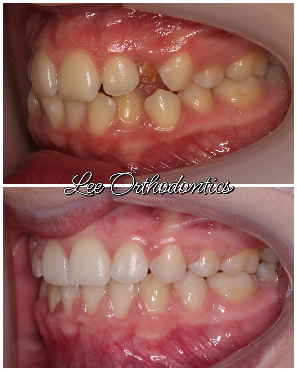 Orthodontic before and after — Case 01