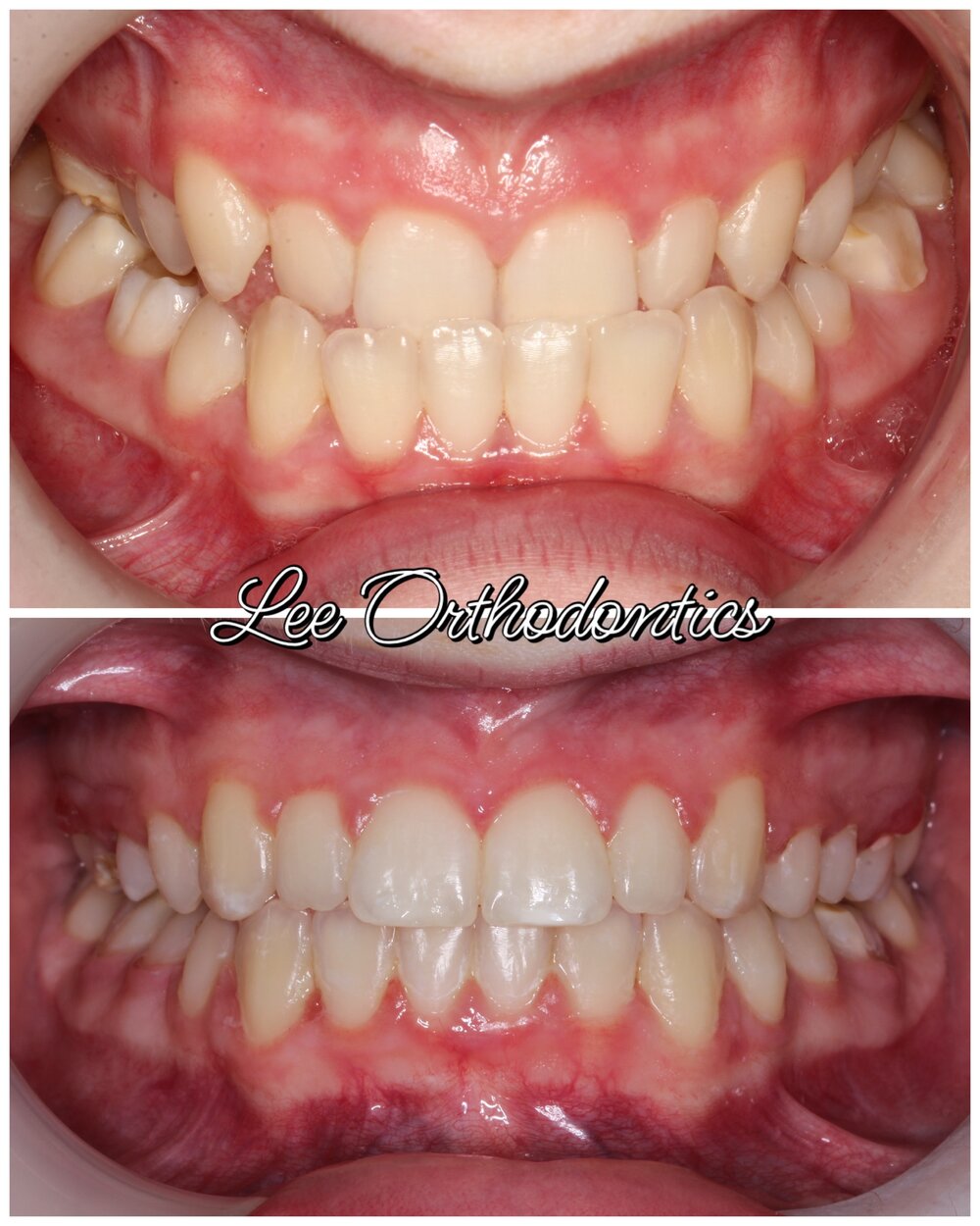 Orthodontic before and after — Case 02