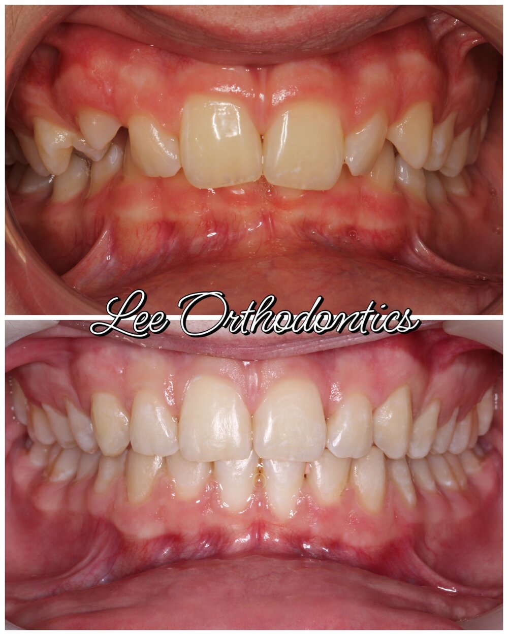 Orthodontic before and after — Case 03