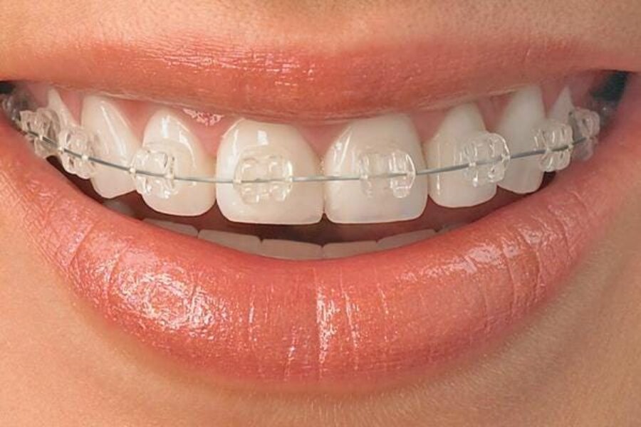 Ceramic tooth-coloured braces