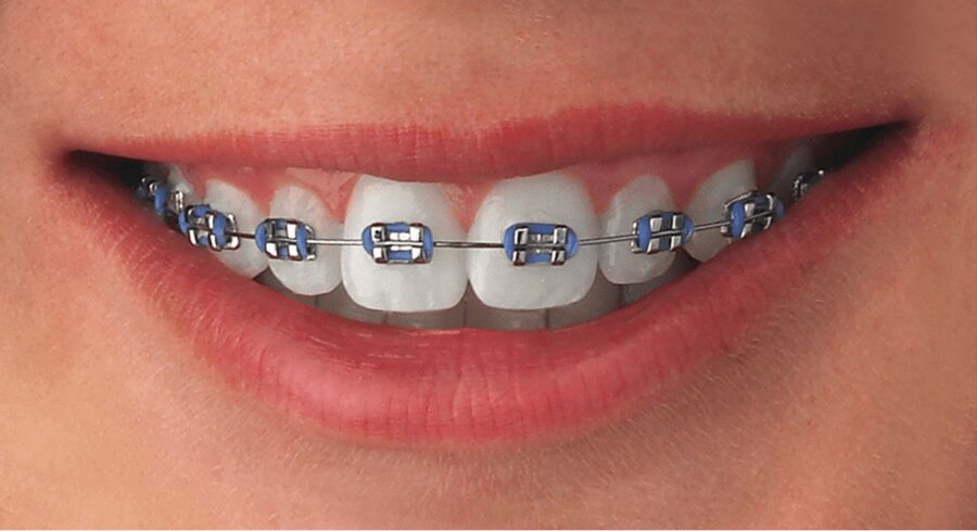 Metal conventional braces