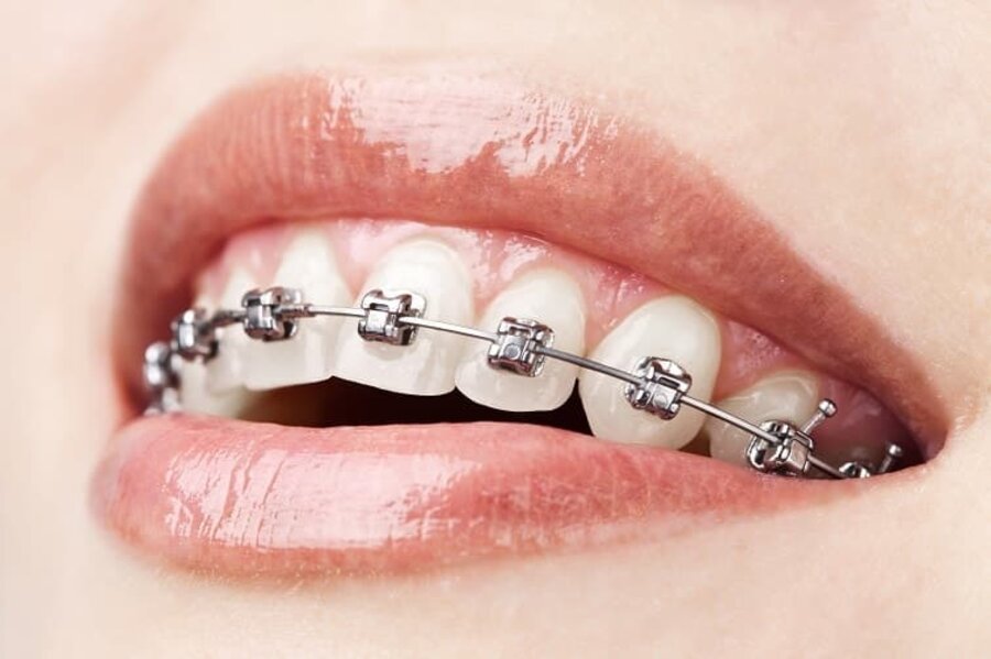 Self-ligating braces close-up