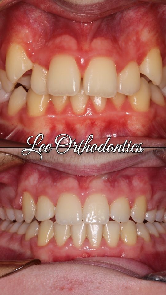 Orthodontic case 1: teeth before and after treatment