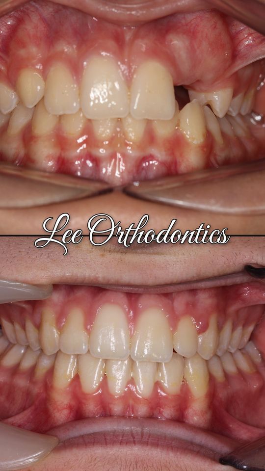 Orthodontic case 4: teeth before and after treatment