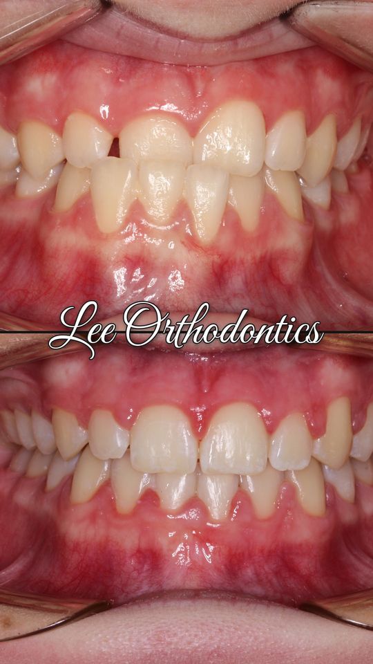 Orthodontic case 5: teeth before and after treatment