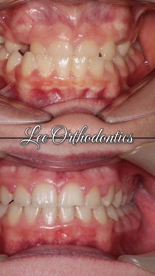 Orthodontic case 6: teeth before and after treatment