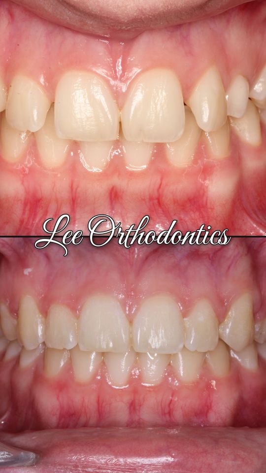 Orthodontic case 10: teeth before and after treatment