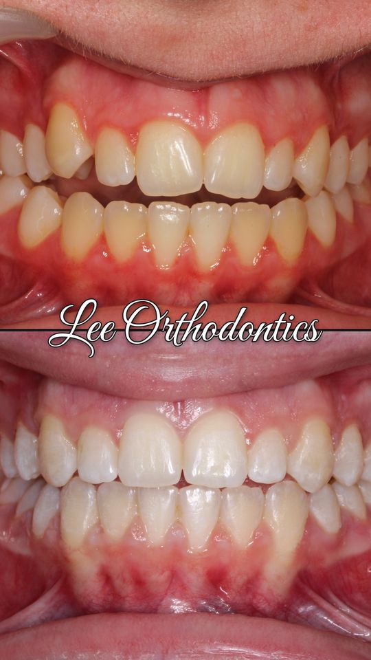Orthodontic case 11: teeth before and after treatment