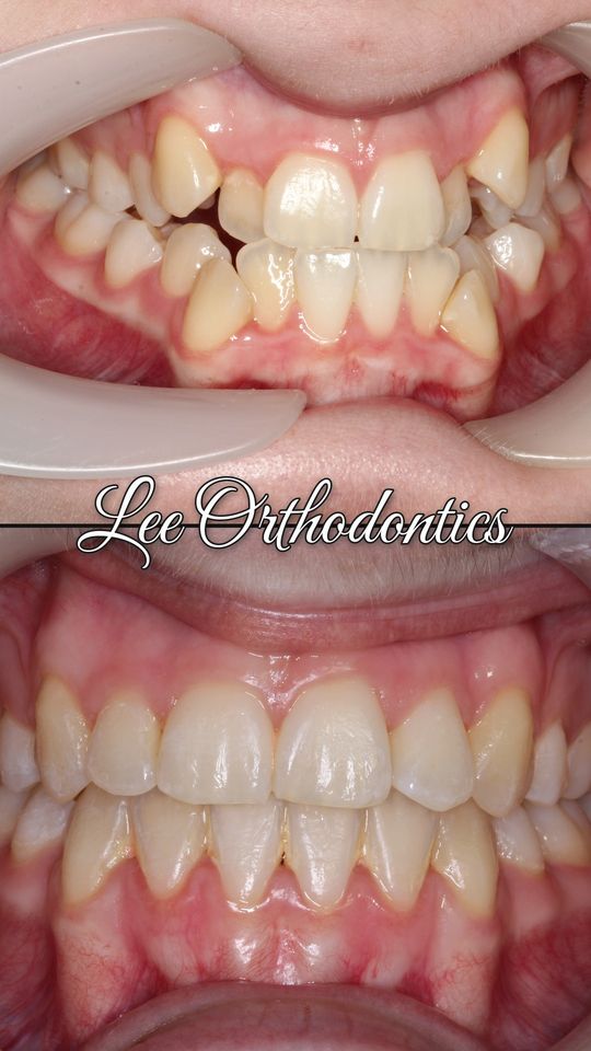 Orthodontic case 20: teeth before and after treatment
